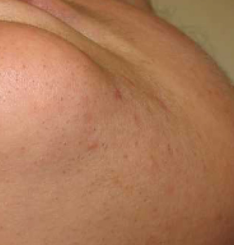 Immagine dopo EpilProLaser mento