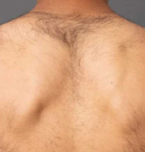 Immagine prima EpilProLaser schiena