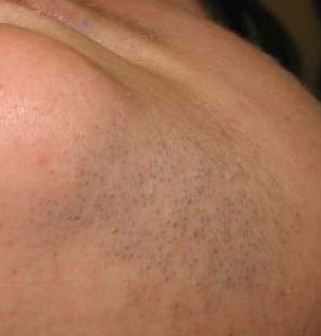 Immagine prima EpilProLaser mento