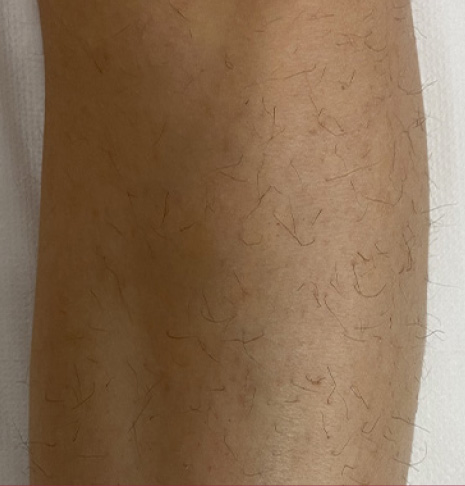 Immagine prima EpilProLaser gamba